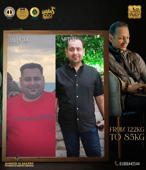كم ينزل الوزن بعد شهر من التكميم